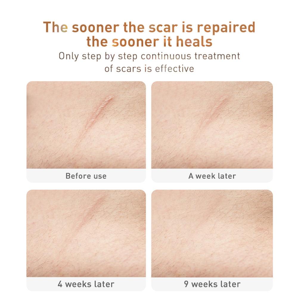 Scar Removal Cream - JuViLu Essentials